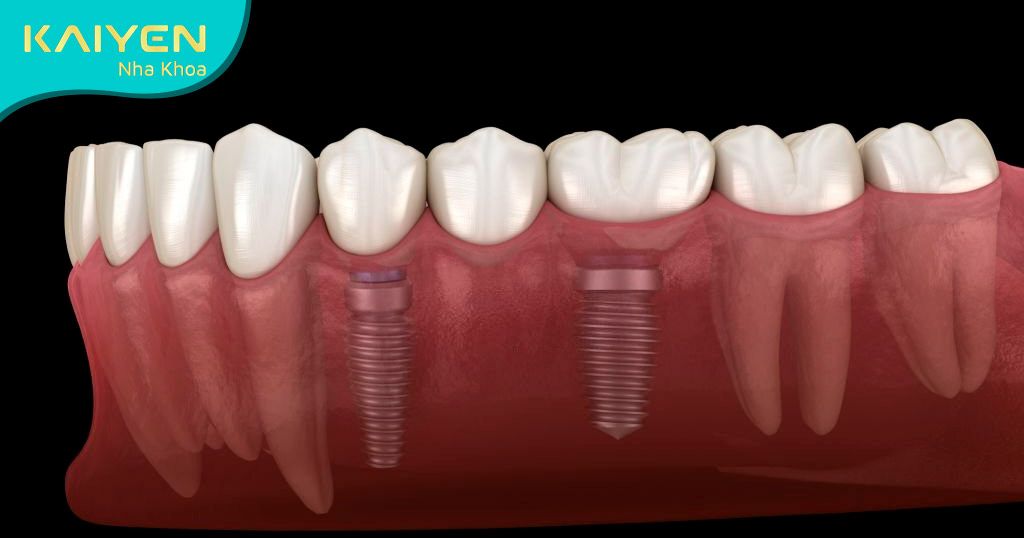 Làm cầu răng sứ trên 2 trụ Implant vẫn đảm bảo độ bền vững