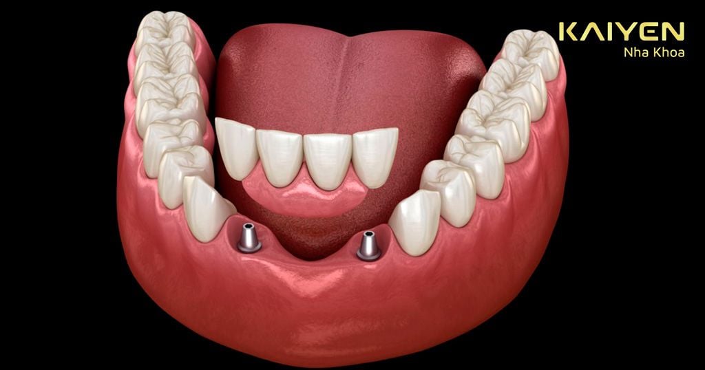 Cấy ghép Implant – Phương pháp trồng răng hiệu quả nhất