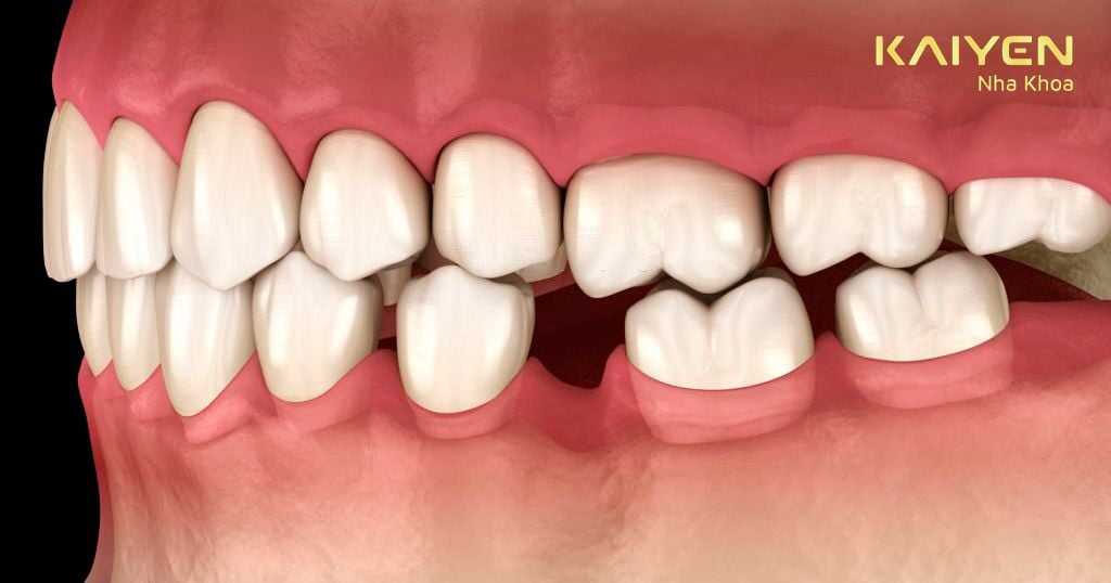 Biến chứng tiêu xương hàm do mất răng gây ra