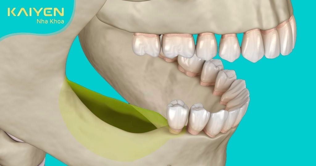 Tiêu xương hàm diễn ra sau khoảng 3 tháng mất răng
