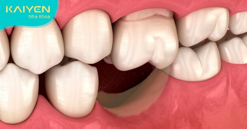 Mất răng tiêu xương hàm có thể dẫn đến lệch khớp cắn