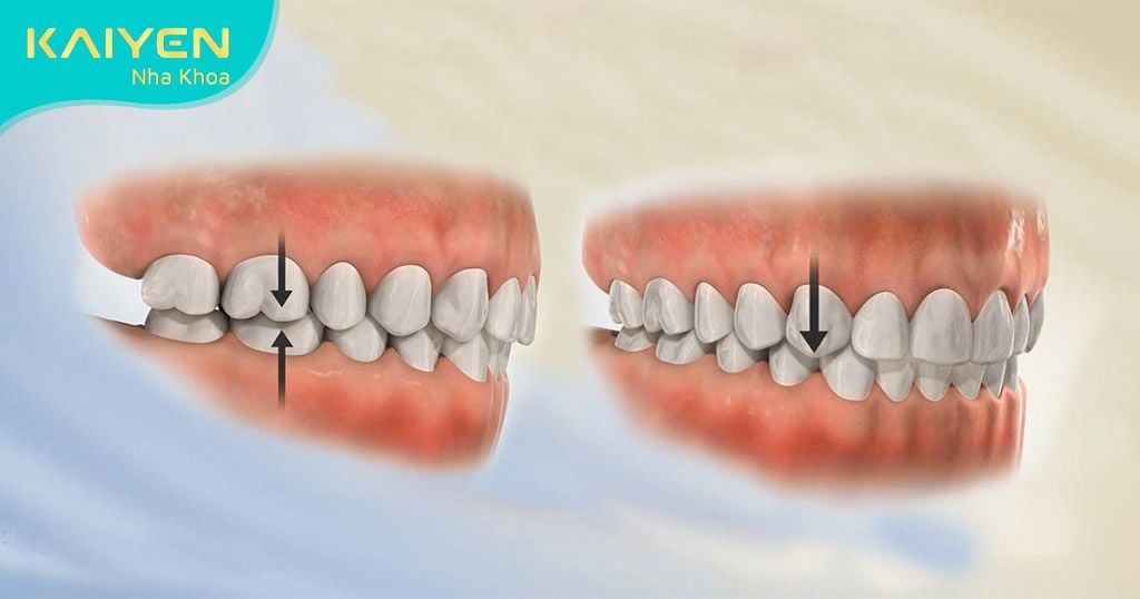 Trường hợp răng móm hay gọi là khớp cắn ngược