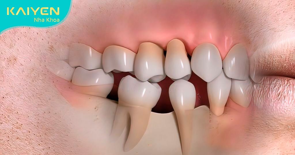 Mất răng khiến tiêu xương hàm gây bị móm