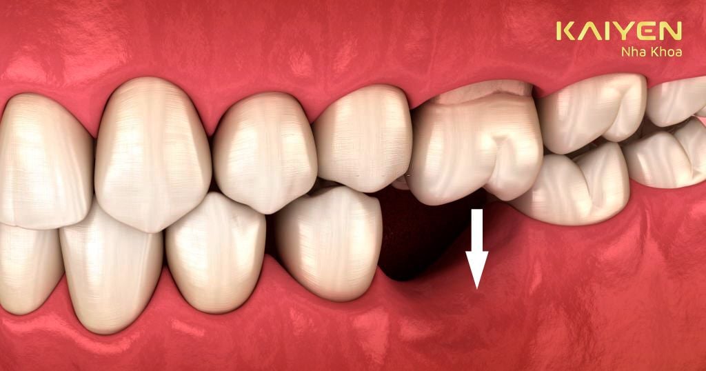 Răng cấm đối diện có xu hướng đổ nghiêng vào vị trí mất răng