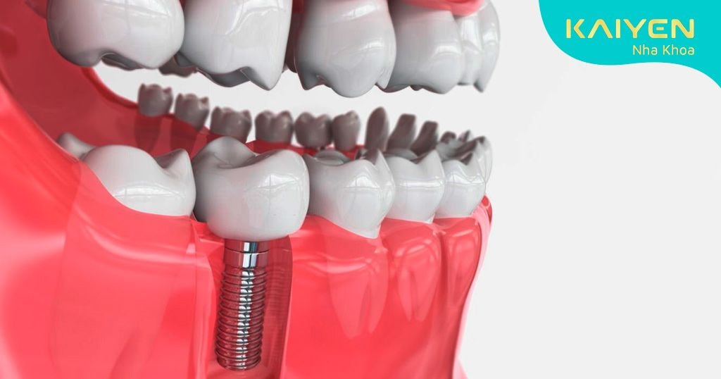 Răng Implant duy trì vĩnh viễn trong xương hàm