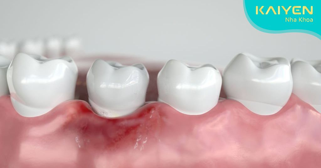 Mất răng hàm gây viêm nướu và các bệnh lý về răng miệng