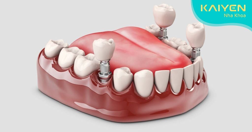 Kỹ thuật trồng răng Implant được nhiều bác sĩ khuyên áp dụng để phục hình răng bị mất