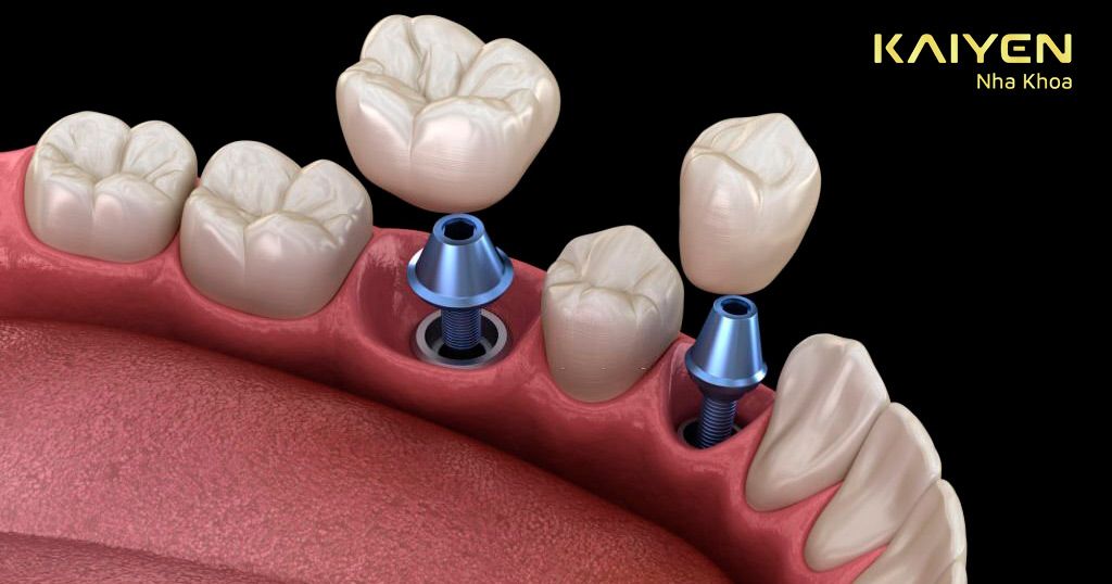 Cấy ghép Implant giúp khắc phục mọi hạn chế của cầu răng sứ