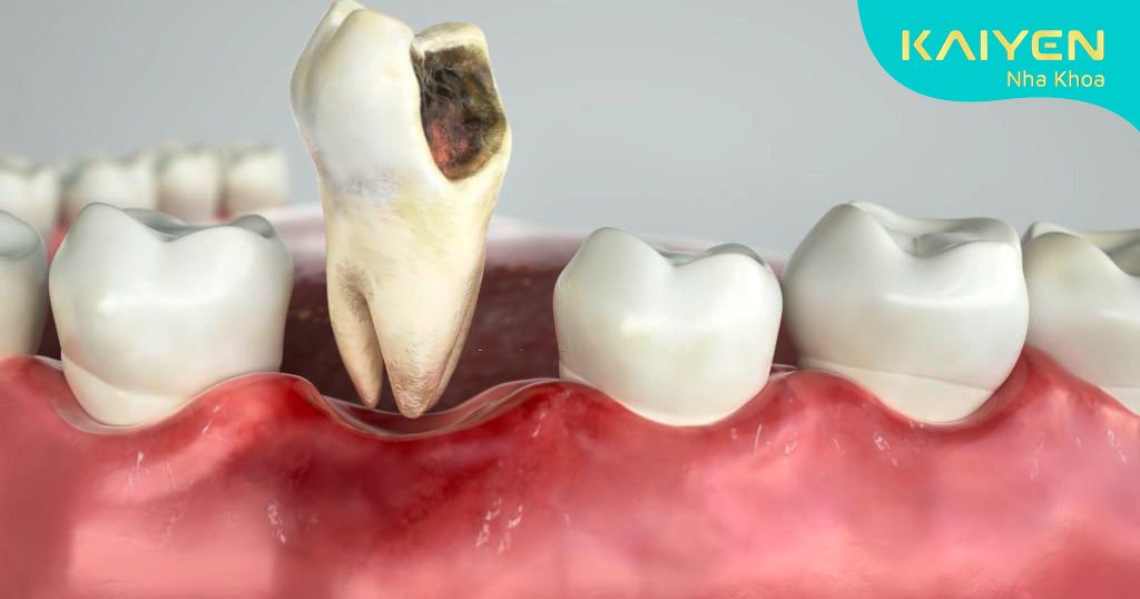 Răng bị đào thải khỏi hàm do sâu và viêm nướu