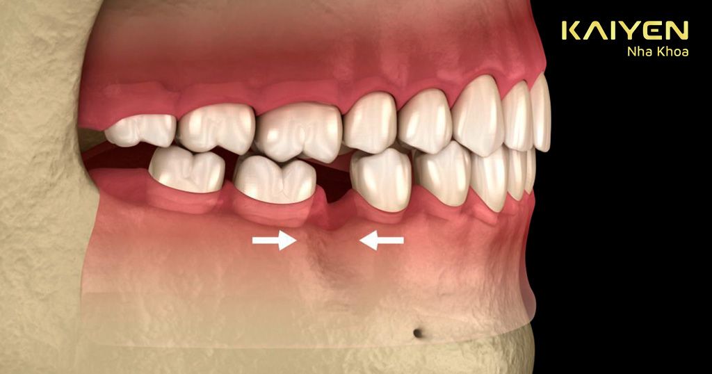 Xương hàm bị tiêu, các răng kế cận đồ nghiêng về vị trí mất răng
