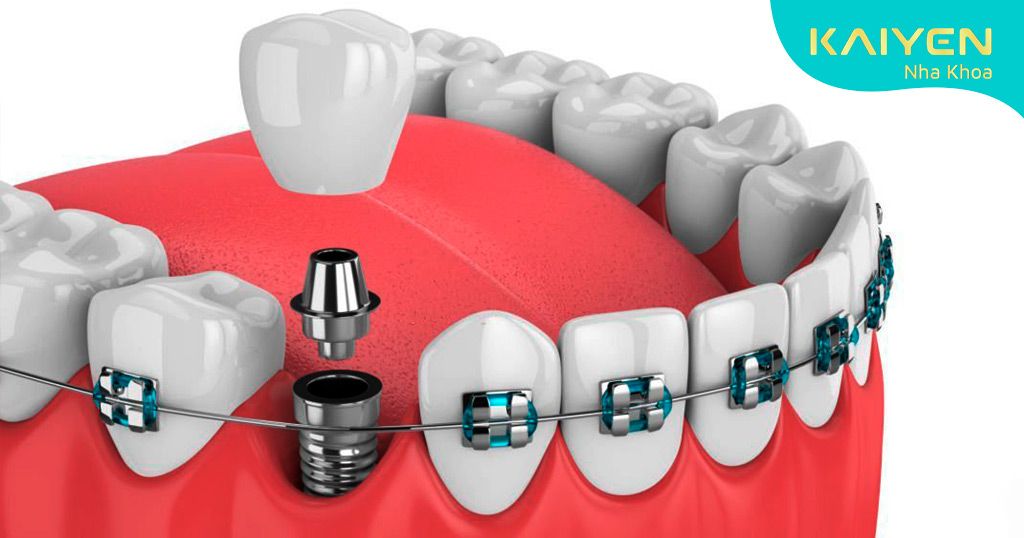 Cấy ghép Implant khi không thể kéo các răng lại gần nhau
