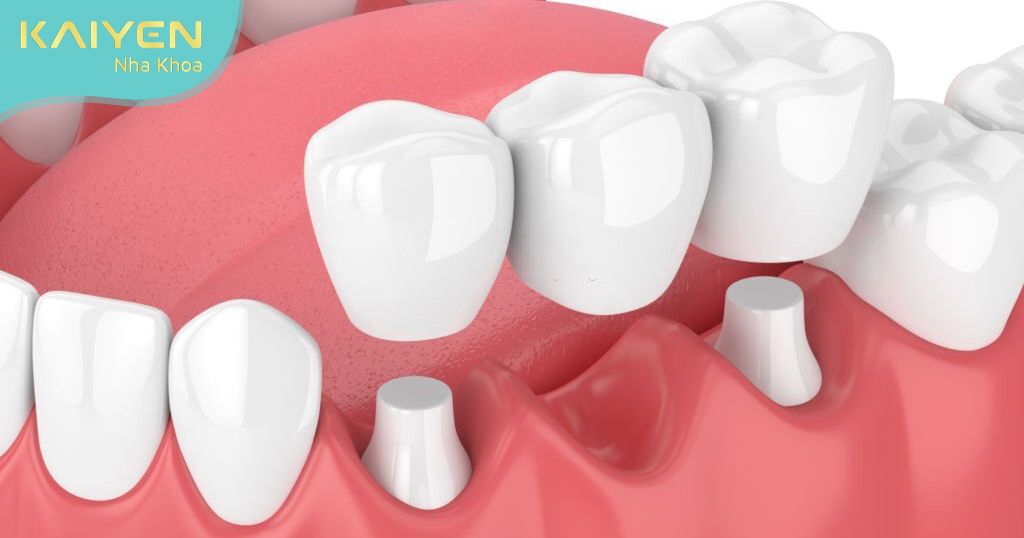 Phục hình răng bằng phương pháp làm cầu răng sứ