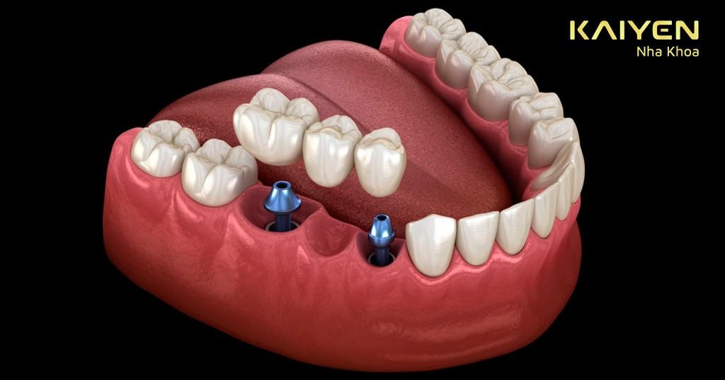 Mô hình hàm răng  dạy bé đánh răng hiệu quả