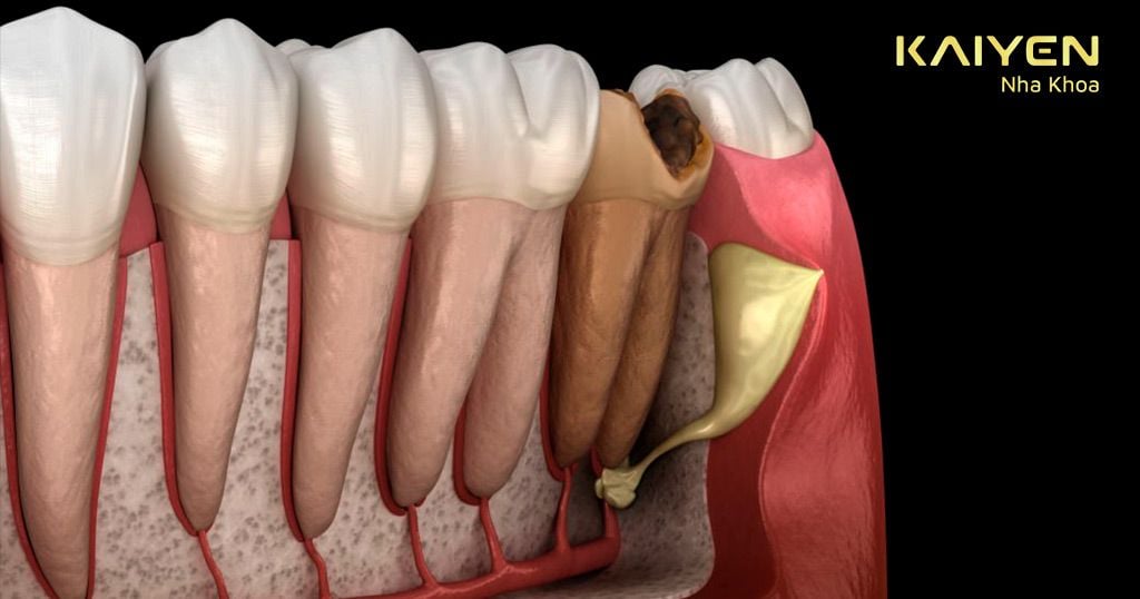 Vệ sinh răng miệng kém có thể gây sâu và mất răng vĩnh viễn