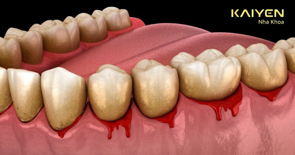 Viêm nướu nếu không khắc phục sớm có thể làm mất răng hàm
