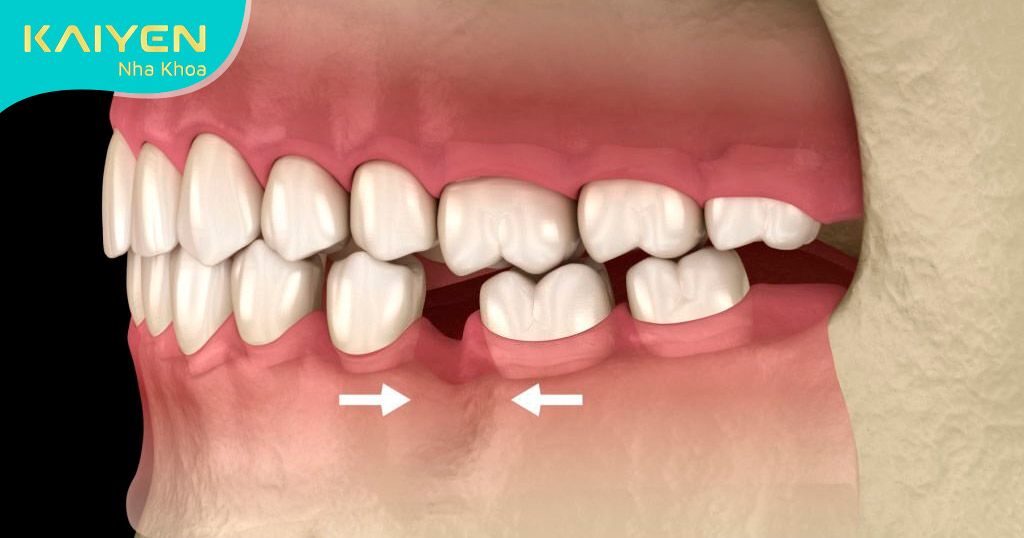 Xô lệch hàm sau mất răng gây sai lệch khớp cắn