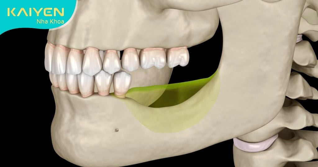 Biến chứng tiêu xương hàm sau một thời gian mất răng