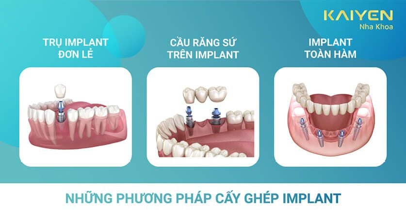 các phương pháp cấy ghép răng implant