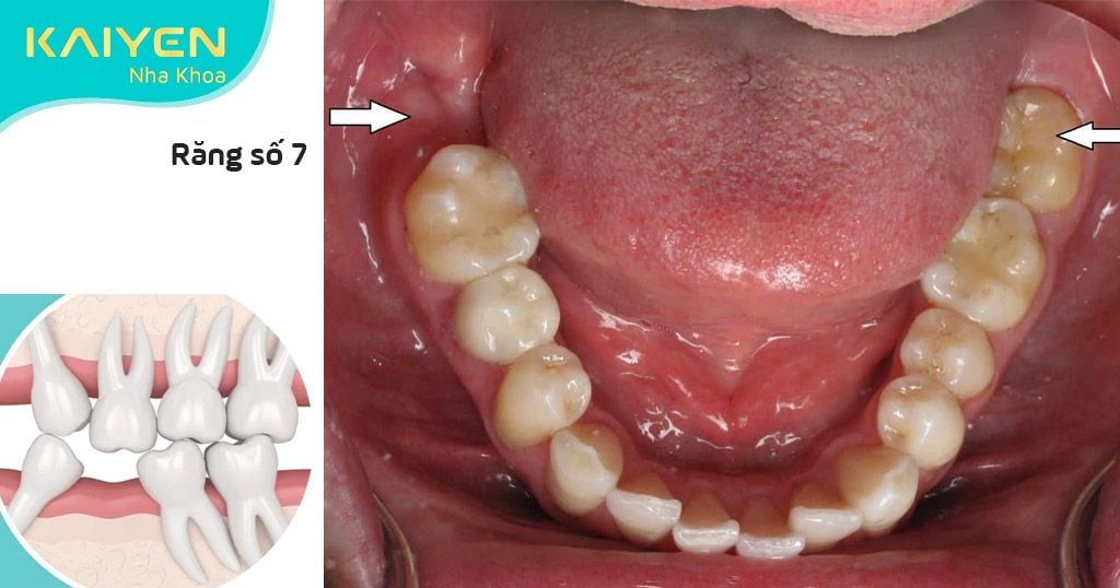 Mô hình hàm răng nha khoa