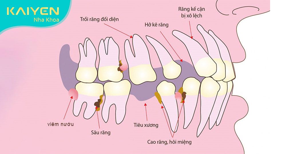 Các hậu quả của việc mất răng nhai hàm dưới