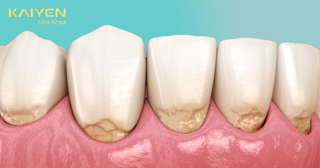 Mòn cổ chân răng có thể dẫn đến mất răng còn chân răng