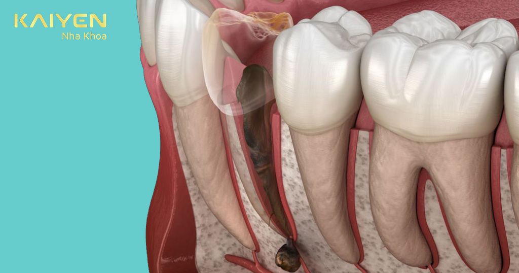 Mất răng có thể dẫn đến viêm nhiễm tủy răng và vùng chóp