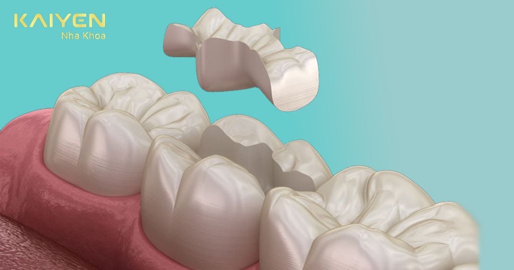 Trám Composite với trường hợp chân răng còn và mô răng thật còn >½ răng