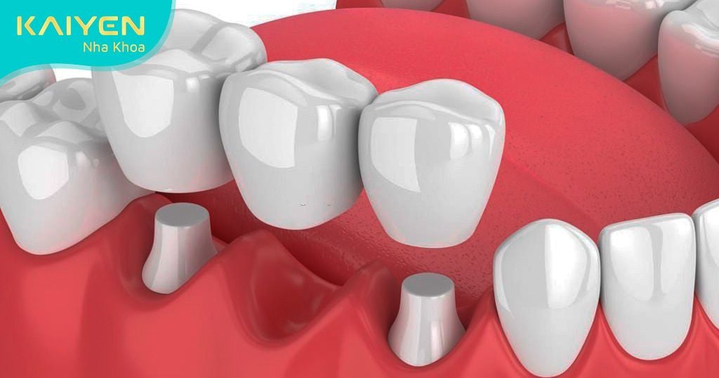 Phục hình răng bằng phương pháp cầu răng sứ