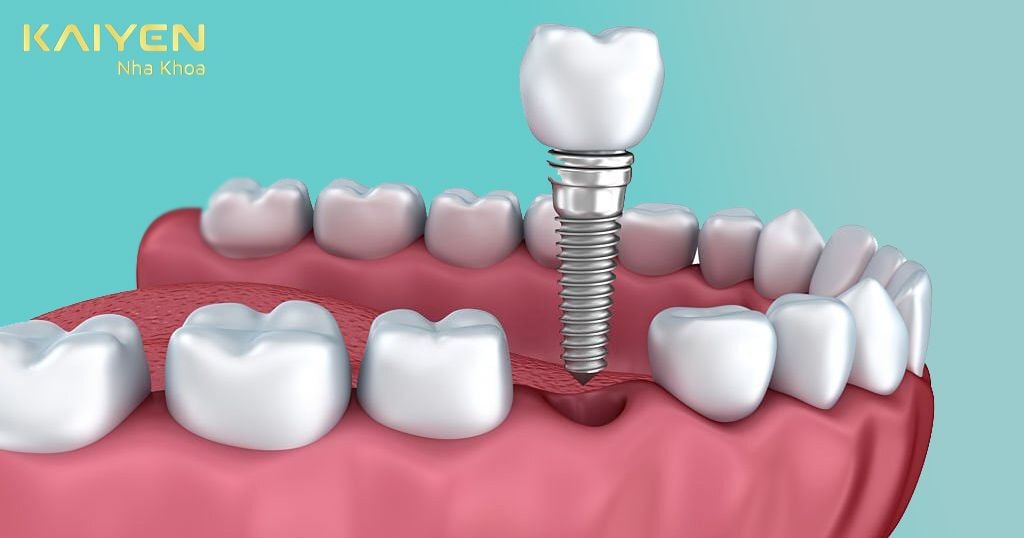 Phục hình răng với phương pháp cấy ghép Implant