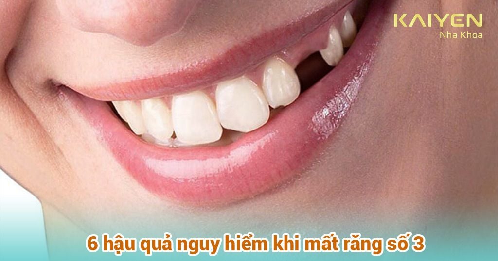 6 hậu quả nguy hiểm khi mất răng số 3