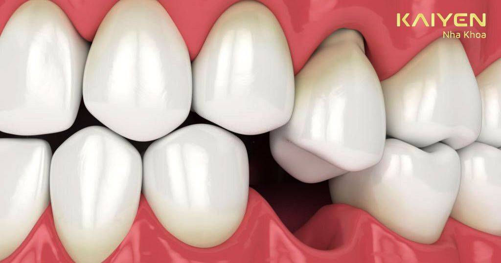 Các răng đổ nghiêng vào vị trí răng số 3 bị mất