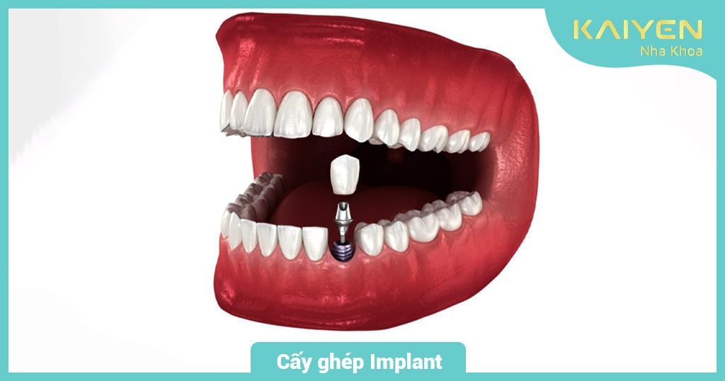 Cấy ghép Implant giúp ngăn chặn tình trạng tiêu xương