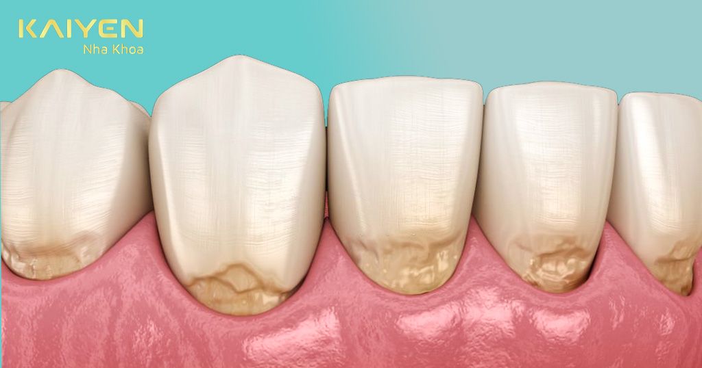 Các bệnh lý răng miệng là nguyên nhân hàng đầu dẫn đến mất răng
