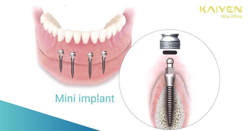 mini implant là gì