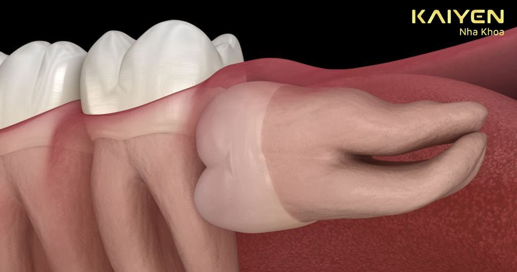 Sốt mọc răng khôn do mọc sai lệch khiến người bệnh đau nhức
