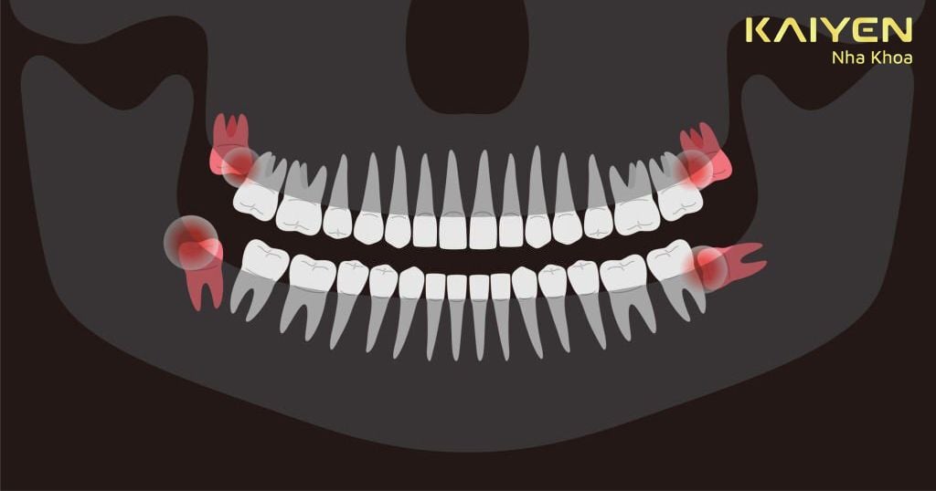 Mọc răng khôn bị sốt do vị trí và hướng mọc của răng trên cung hàm