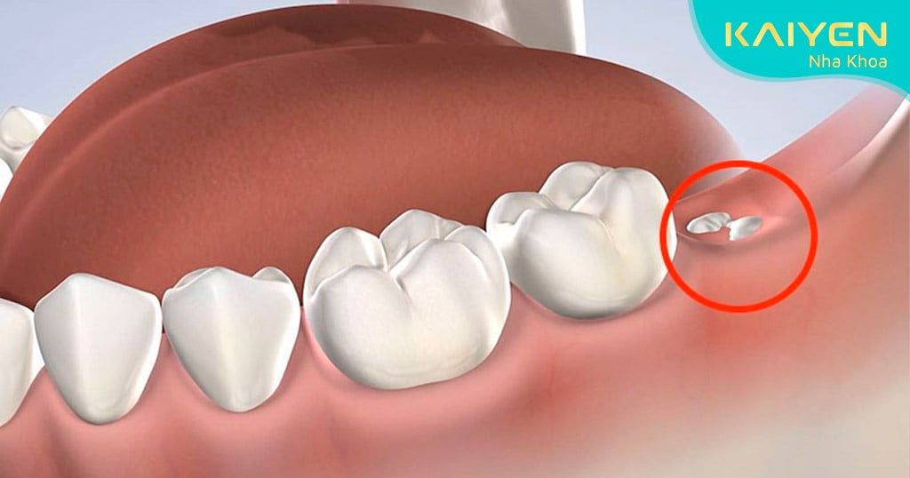 Mọc khôn mọc mất vài năm để mọc hoàn thiện