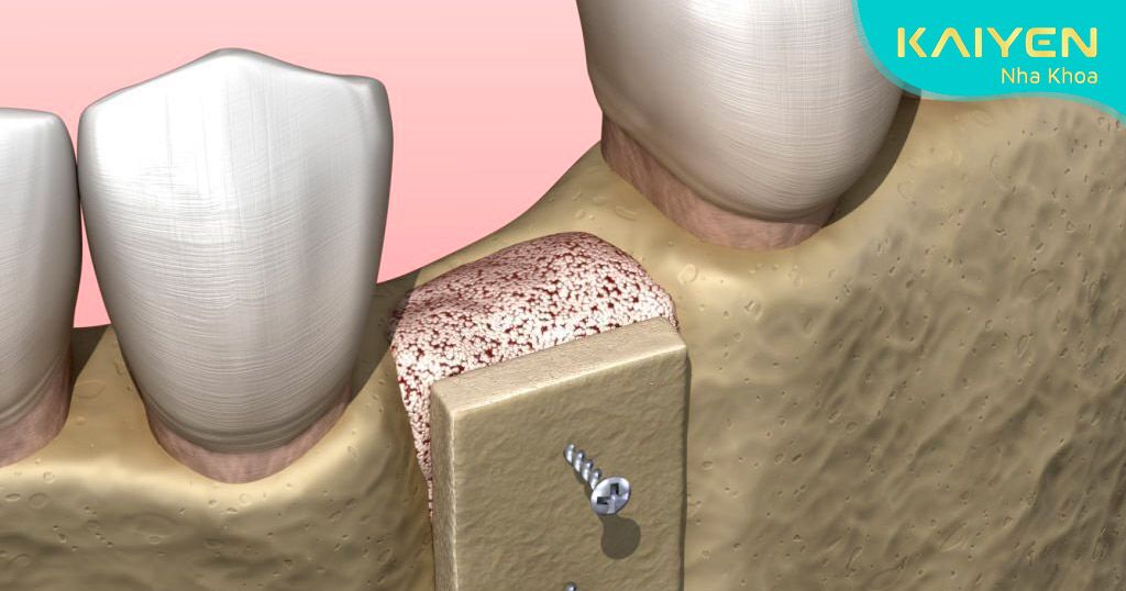 ghép xương hàm trước khi trồng răng Implant
