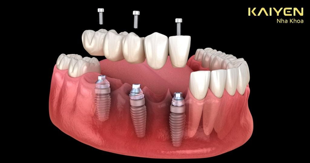 Phục hình răng Implant liền nhau