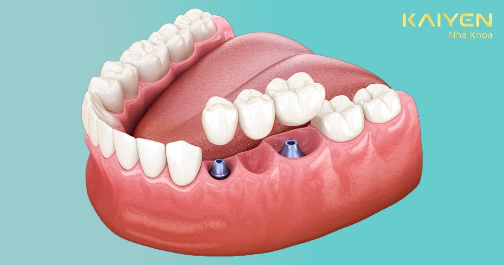 Răng giả cố định Implant