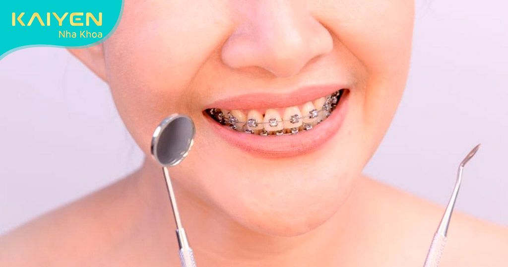 Niềng răng chỉnh nha vừa mang lại nụ cười đẹp vừa giúp cải thiện chức năng răng