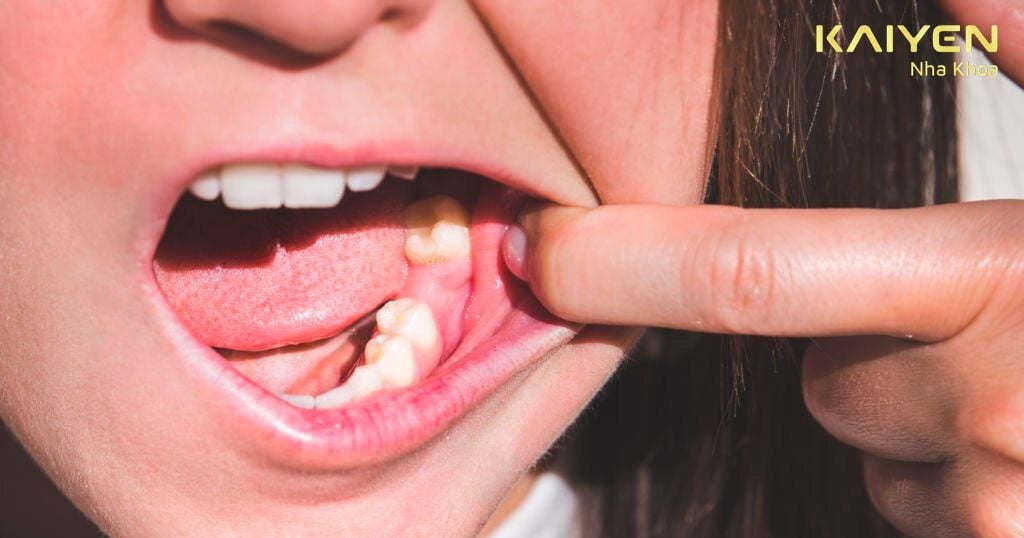 Tình trạng người trẻ tuổi bị mất răng sớm