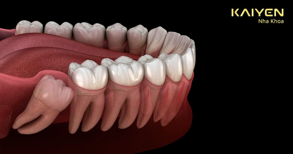 Răng khôn thường mọc lệch, mọc xiên ngang hoặc mọc ngầm gây đau nhức kéo dài