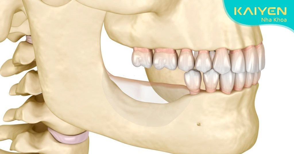 Sau mất răng có hiện tượng tiêu xương hàm