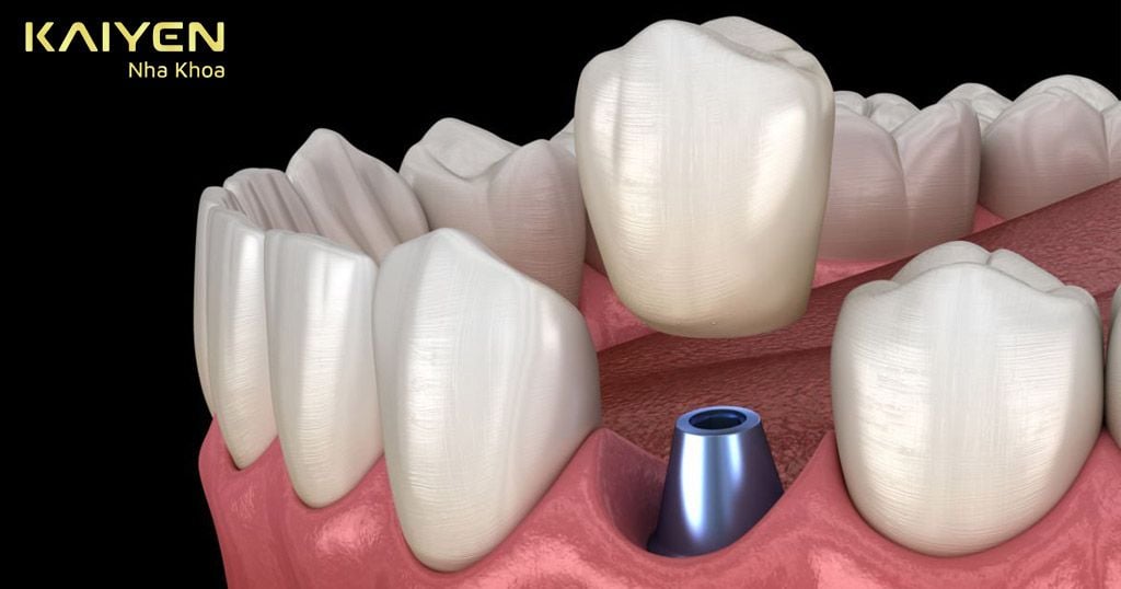 Cấy Implant tức thì sau nhổ răng