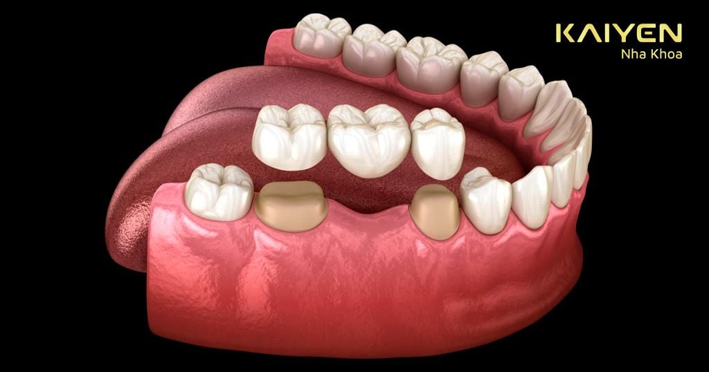 Thời gian làm cầu răng sứ mất từ 2 – 4 ngày và có thể sử dụng trong 7 – 10 năm