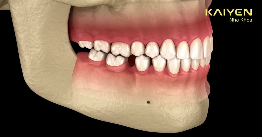 Biến chứng tiêu xương hàm ở vị trí răng mất