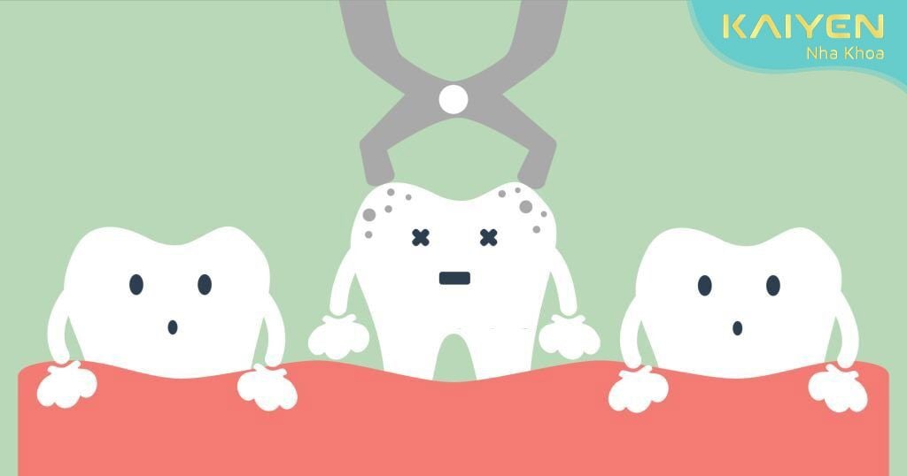 Bệnh nhân được tiến hành nhổ răng khi không có bệnh lý răng miệng cấp tính
