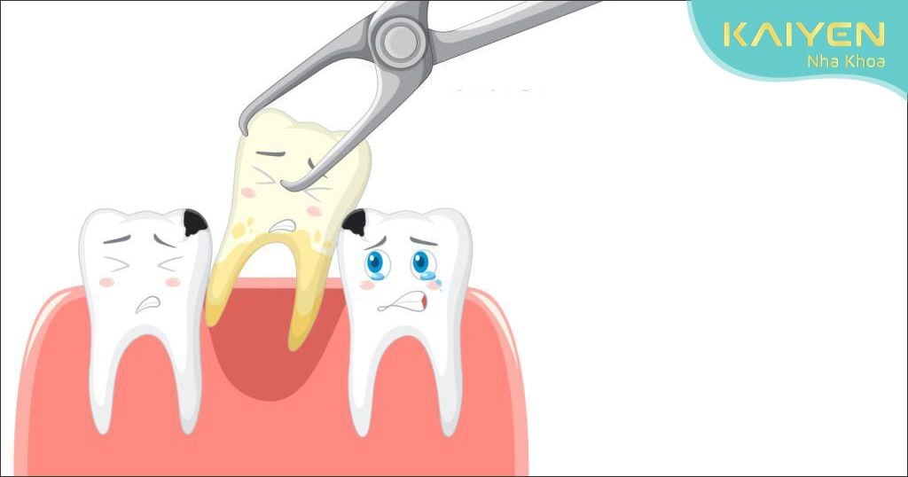 Giá nhổ răng hết bao nhiêu tiền tùy thuộc vào từng tình trạng răng