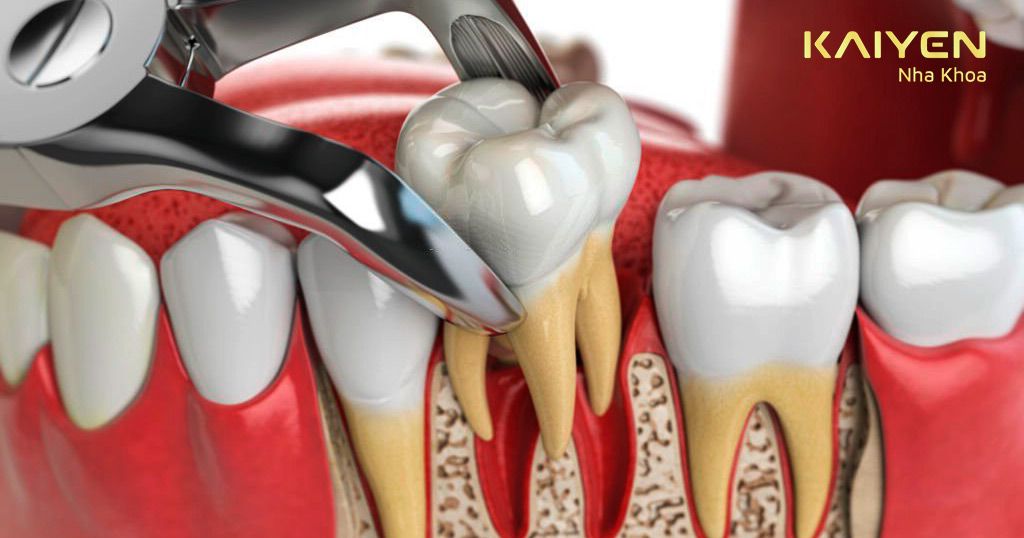 Nhổ răng không gây ảnh hưởng đến trí nhớ